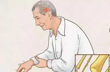 Progresso Rivoluzionario nella Cura del Parkinson con Cellule Staminali Indotte